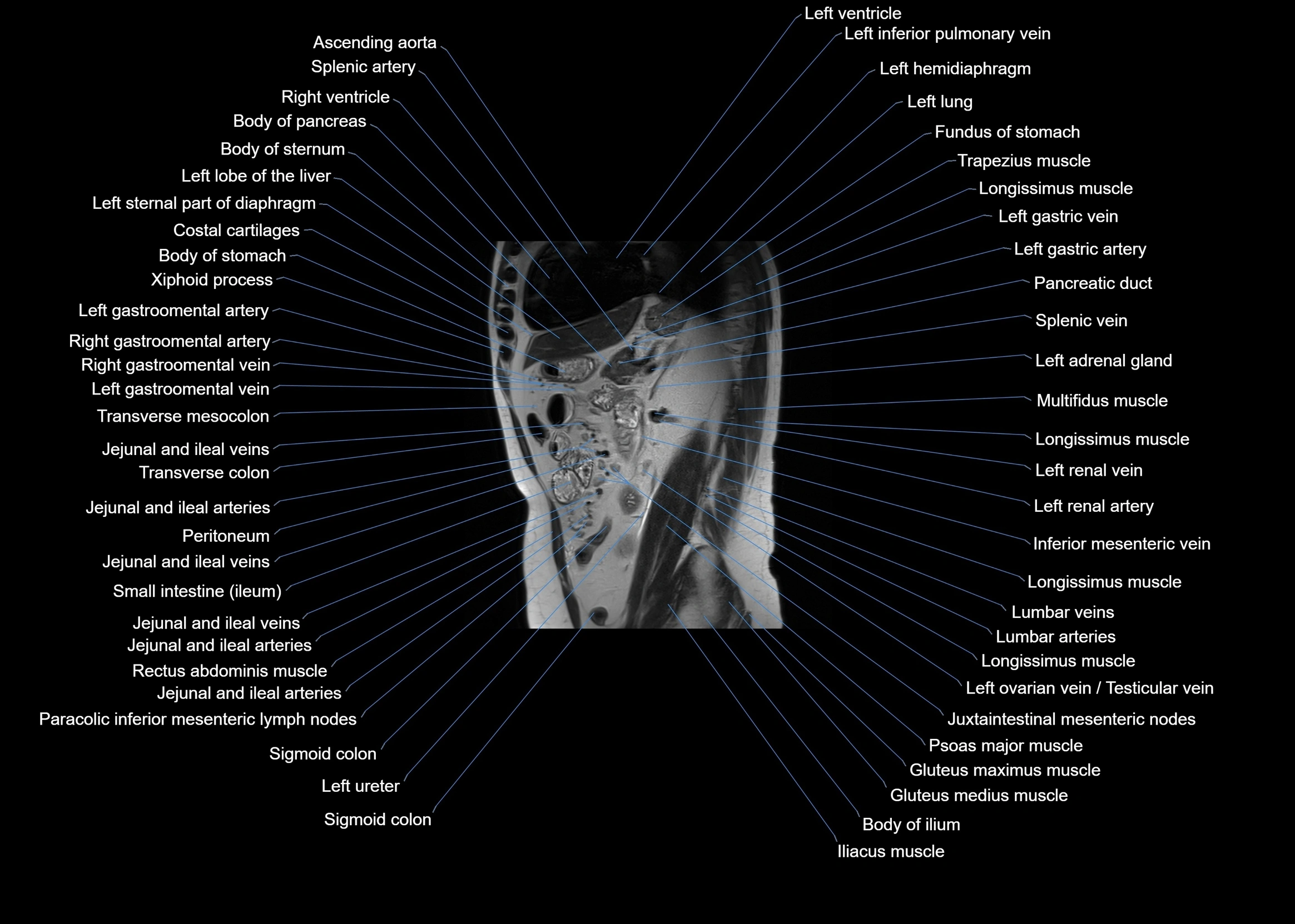 MRI abdomen sagittal cross sectional anatomy  radiology  image-img-00001-00044.webp